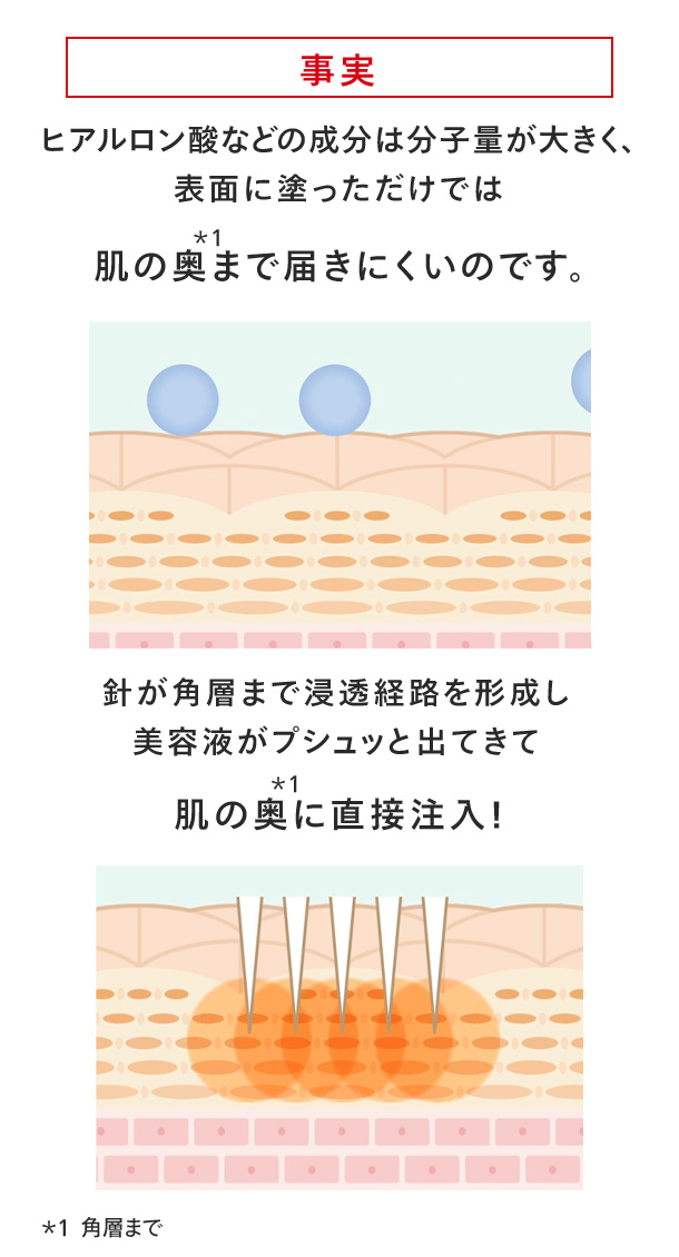 針が角層まで浸透経路を形成し美容液がプシュッと出てきて肌の奥に直接注入