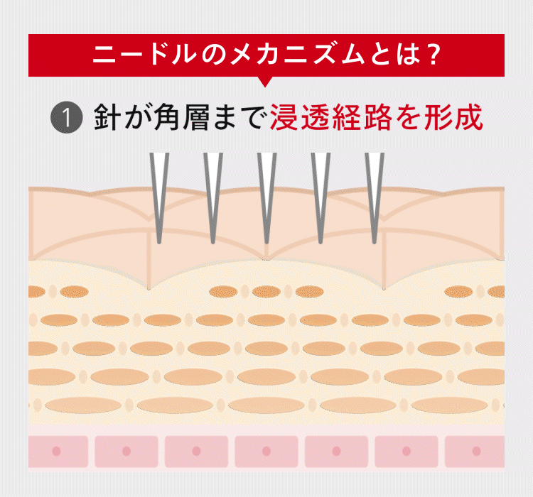 ニードルのメカニズムとは？